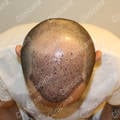 2 days after hair transplant