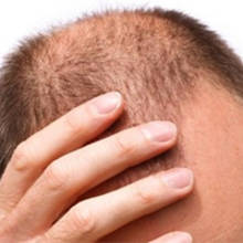 كيف تعرف ما إذا كنت على وشك الإصابة بالصلع، وكيف تمنع ذلك؟