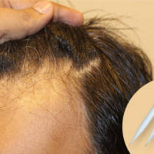 DHI hair transplant in Turkey using the Choi pen