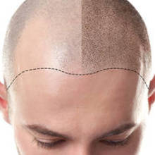 Mesotherapy for hair loss: Does it help hair regrowth?