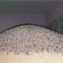 Die Kruste nach der Haartransplantation
