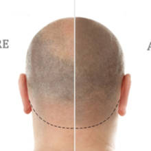 Mikropigmentierung kopfhaut (Micro-Haarpigmentierung)