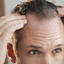 Haartransplantation an der Krone (Vertex)