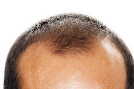 Greffe de cheveux Turquie pas cher