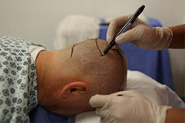 Greffe de cheveux en Turquie