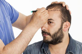 Greffe de cheveux Tuquie 2019