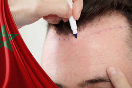 أيهما أفضل زراعة الشعر في المغرب أو تركيا