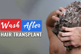 الطريقة الصحيحة ل غسل الشعر بعد اجراء عملية زراعة الشعر