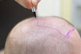 زراعة الشعر في تركيا أو بريطانيا: ماهي الاختلافات؟