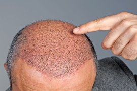 Странични ефекти при трансплантация на коса