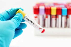 ¿Puedo someterme a un trasplante capilar con hepatitis B?