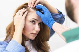 Alopecia androgénica en la mujer: ¿tiene tratamiento?