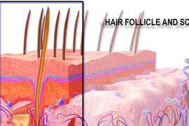 وحدات بصيلات الشعر و زراعة الشعر