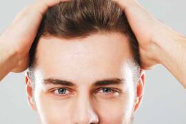 الأعراض الجانبية لزراعة الشعر ومخاطرها