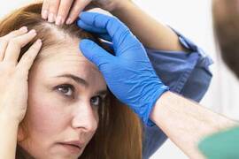 الصلع الذكوري النمطي عند النساء: ما هو العلاج؟