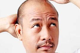 Minoxidil: resultados y efectos secundarios