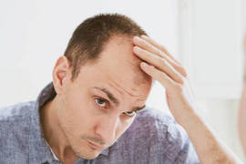 الشعر الاصطناعي أم عملية زراعة الشعر: أيهما الأفضل؟