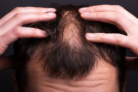 الصدفية وتساقط الشعر: الأسباب،الأعراض والعلاج