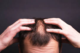 Psoriasis and hair loss: causes, symptoms & treatment