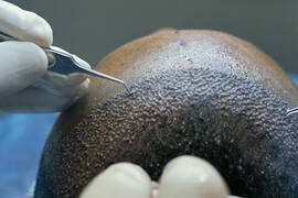 FUE vs. DHI Hair Transplant in Turkey: Understanding the Differences & Choosing the Right Option