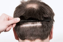 Донорска област при трансплантация на коса