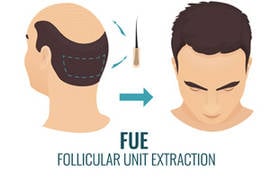 ميزات تقنية الاقتطاف في زراعة الشعر و الاثار الجانبية