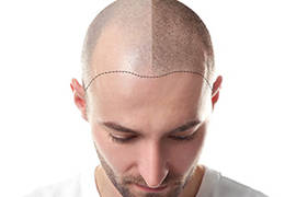مراحل عملية زراعة الشعر