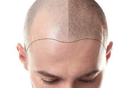 ¿Qué es la mesoterapia capilar, y qué resultados consigue?