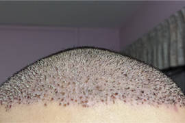 القشور بعد عملية زراعة الشعر
