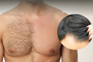 Greffe de cheveux à partir des poils du torse et de la barbe