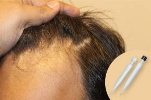 Hair Transplant Using the Implanter Pen (Choi DHI Method)