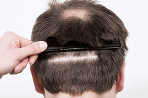 المنطقة المانحة في عملية زراعة الشعر