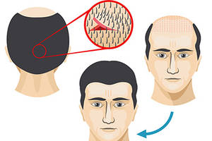 زراعة الشعر بطريقة الشريحة FUT