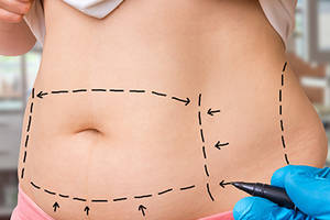 Liposuction Techniques and Advantages