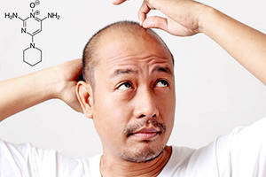 هل يعتبر المينوكسيديل بديلاً عن عملية زراعة الشعر؟