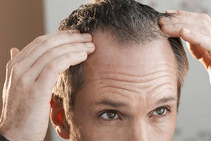 Hair transplant on top of head (Crown area)