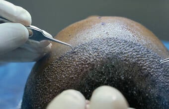 FUE vs. DHI Hair Transplant in Turkey: Understanding the Differences & Choosing the Right Option
