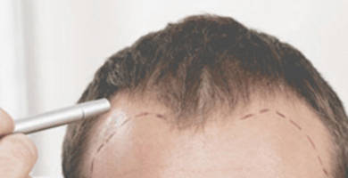 Implant de par cluj