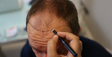 Greffe cheveux Turquie