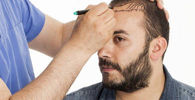 Greffe de cheveux Tuquie 2019