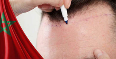 أيهما أفضل زراعة الشعر في المغرب أو تركيا