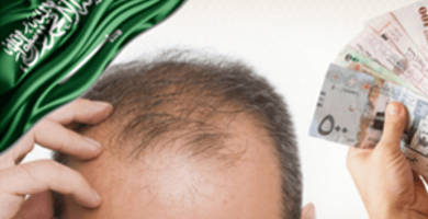 زراعة الشعر في السعودية