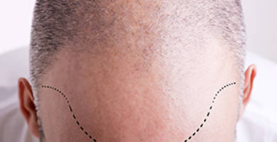 Meilleur clinique greffe de cheveux turquie forum