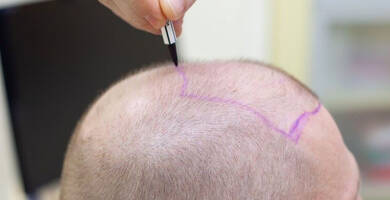 زراعة الشعر في تركيا أو بريطانيا: ماهي الاختلافات؟