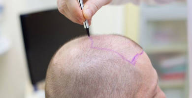 Diferencias entre un trasplante capilar en España o Turquía