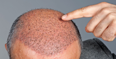 Странични ефекти при трансплантация на коса