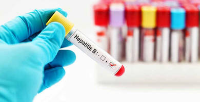 ¿Puedo someterme a un trasplante capilar con hepatitis B?