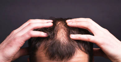 ¿Se puede realizar un trasplante de pelo con psoriasis?