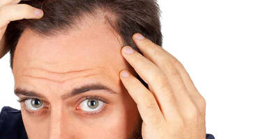 Preguntas y respuestas sobre el trasplante de pelo