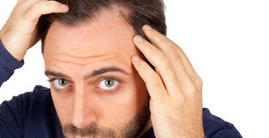 Hair transplant: Questions and answers